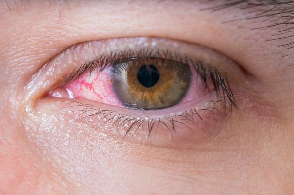 Vörös szem? Okozhatja szemszárazság, allergia vagy súlyos szembetegség is
