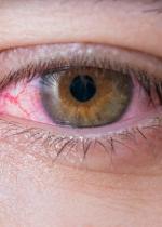 Vörös szem? Okozhatja szemszárazság, allergia vagy súlyos szembetegség is